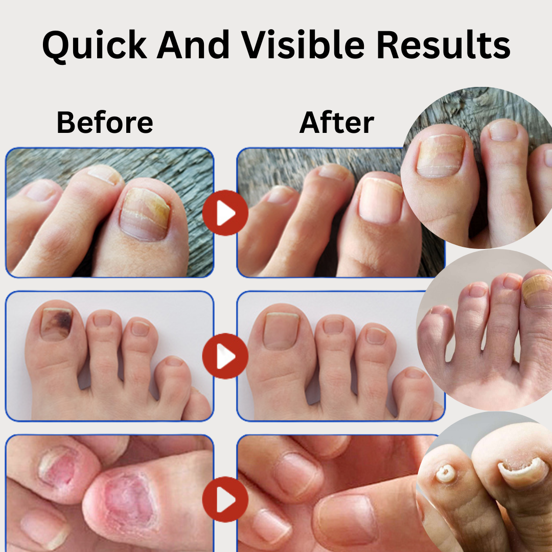 Overnight Fungal Nail Repair – 21 Patches