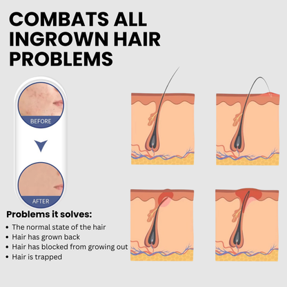 After Shave Ingrown & Dark Spot Fix