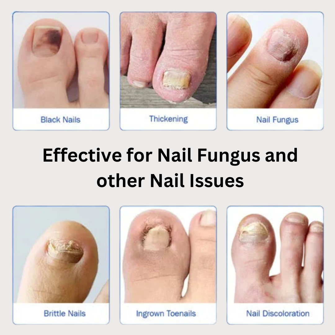 Overnight Fungal Nail Repair – 21 Patches
